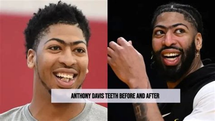 Unveiling The Secrets Behind Anthony Davis' Transformed Smile
