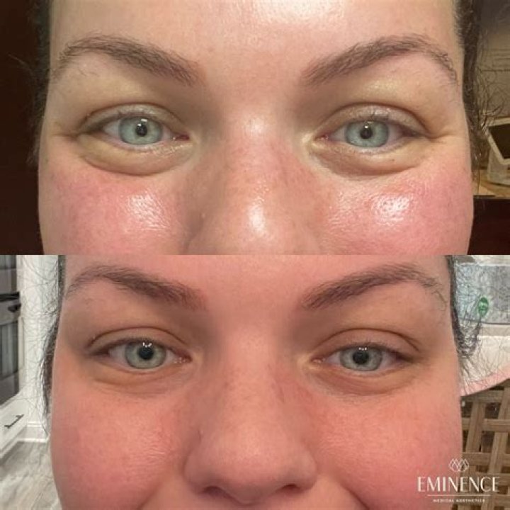 Uncover The Secrets Of Jelly Roll Botox: A Journey Of Transformation