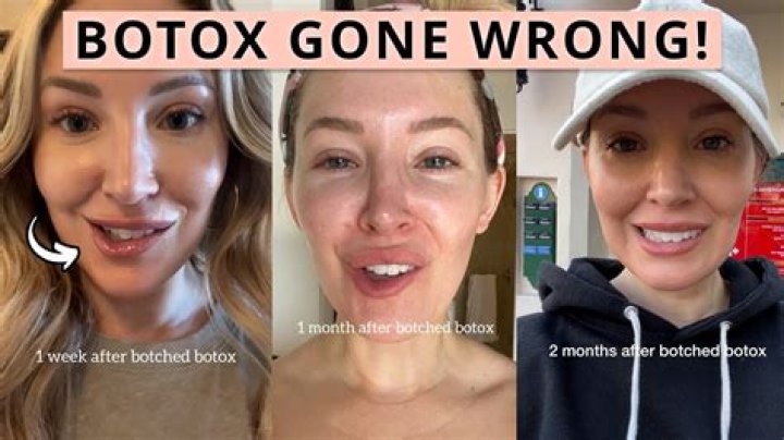 Unveiling The Hidden Dangers: Botox Gone Wrong