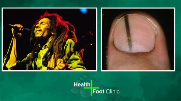 Exploring The Mystery Behind Bob Marley's Toe Injury