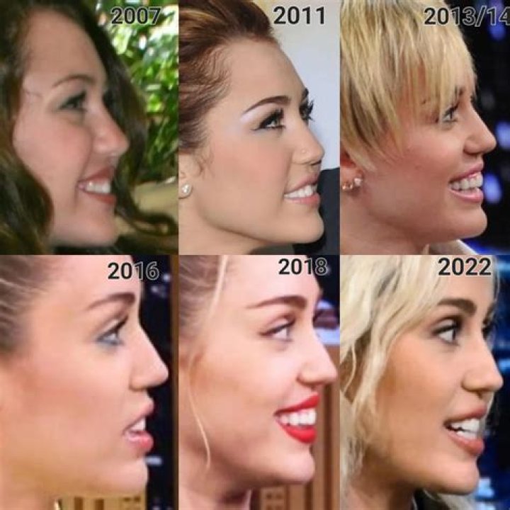 Miley Cyrus's Plastic Surgery Journey Explored