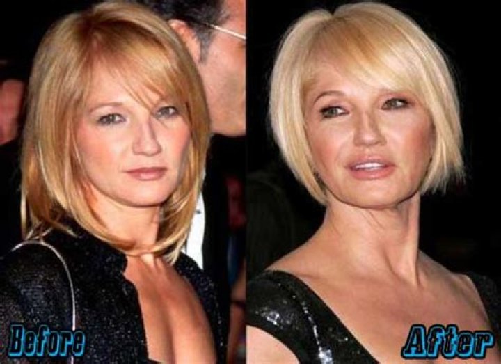 Unlock The Secrets Of Ellen Barkin's Plastic Surgery Journey