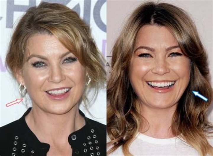 Ellen Pompeo's Botox Journey And Expert Insights