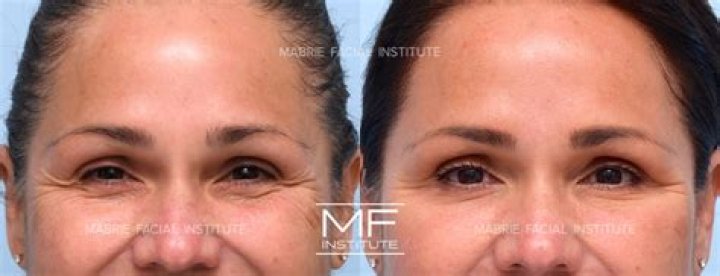 Jelly Roll Botox Before And After Revealed