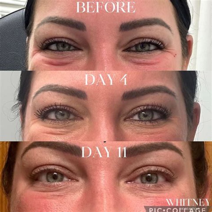 Unveiling The Secrets Of Jelly Roll Under Eye After Botox