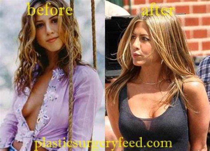 Jennifer Aniston's Breast Augmentation Secrets Revealed
