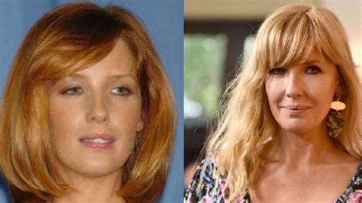 Kelly Reilly's Lip Injections Journey