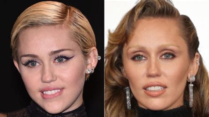 Miley Cyrus's Buccal Fat Removal Surgery Unveiled