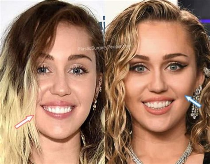 Revealing Miley Cyrus's Rhinoplasty Journey: Surprising Insights