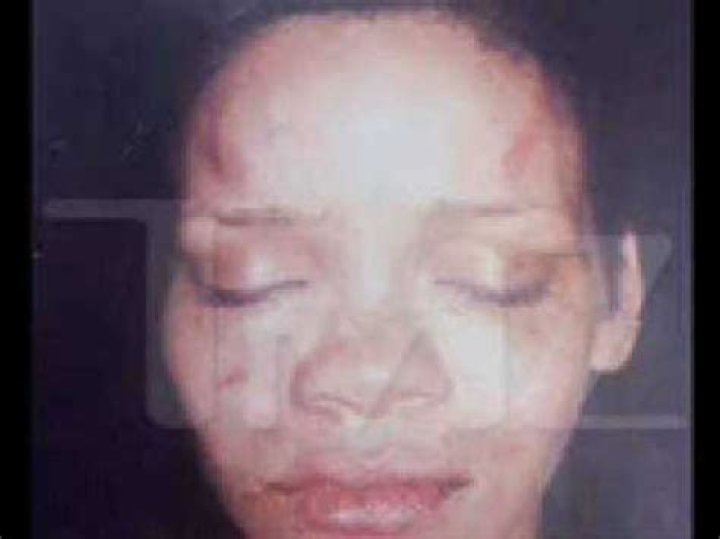 Rihanna's Injuries: Uncovering Hidden Truths
