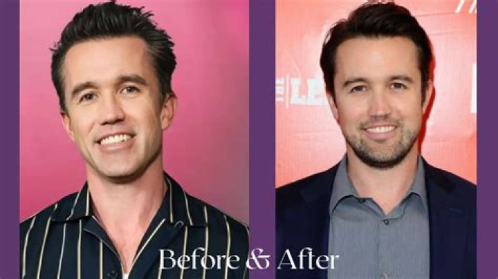 Rob McElhenney's Plastic Surgery Journey Explored