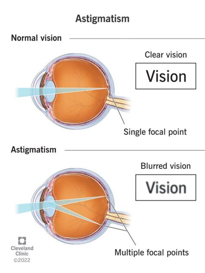 Unlock The Secrets Of Stigmatism: Unveiling Clarity