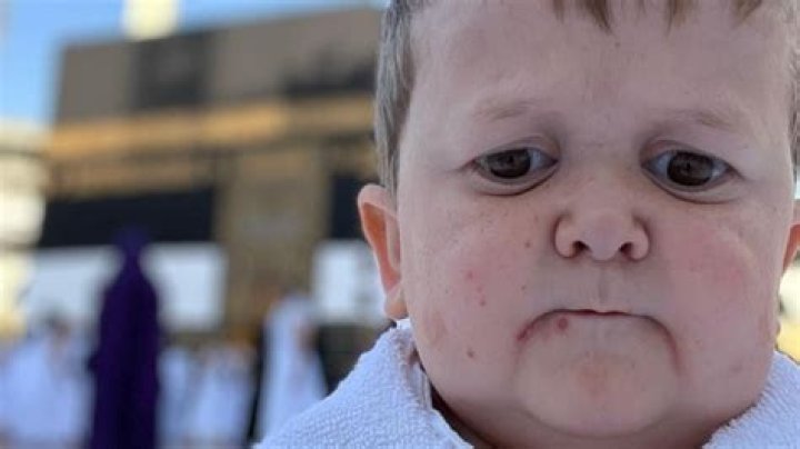 Exploring The Medical Condition Behind Hasbulla's Unique Appearance